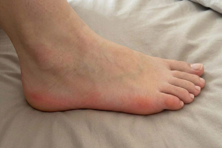 Stechende Schmerzen Fußaußenkante